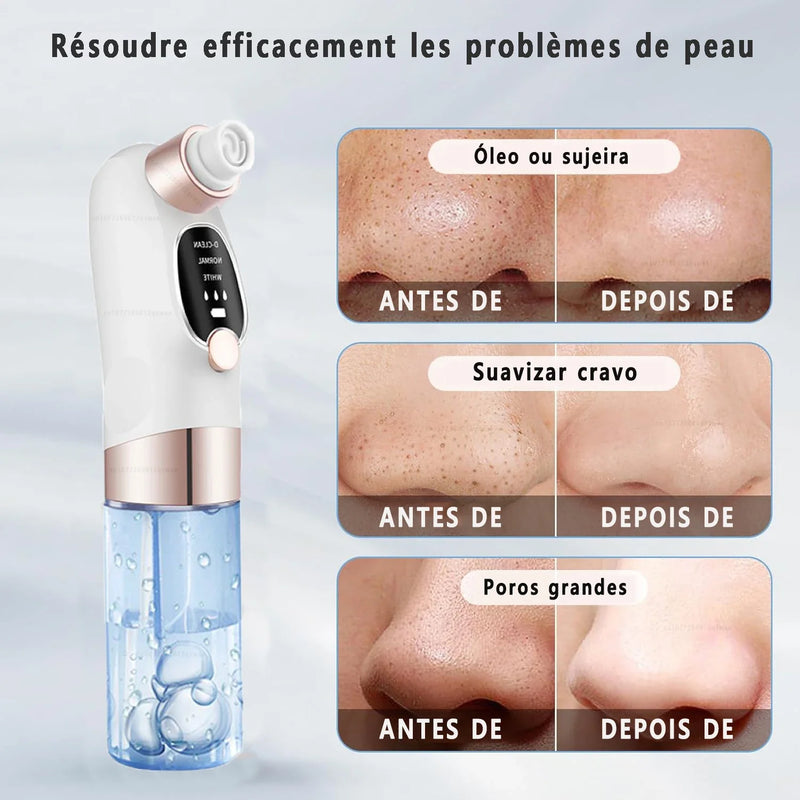 Removedor de Cravos Elétrico com Função de Sucção e Ciclo de Água - Limpeza Profunda de Poros, Acne e Cravos, USB Recarregável